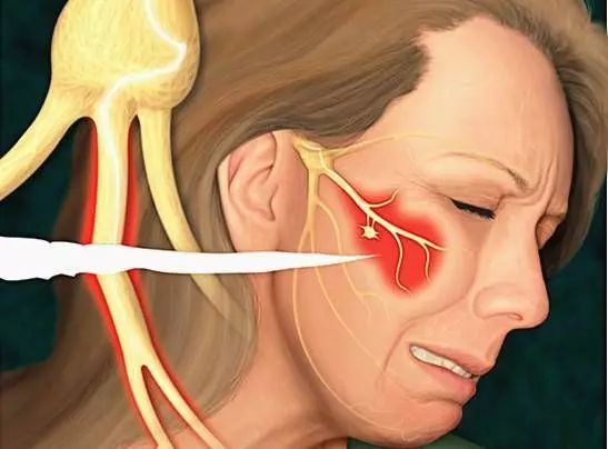 三叉神經痛病人突然發作是什麼樣的？為何令人痛苦不堪？